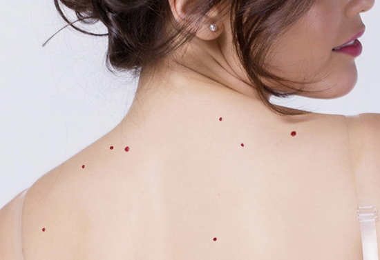 Você tem esses pontos vermelhos em algum lugar do seu corpo? Descubra o que são e como surgem!