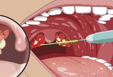 Caseum: o que é e quais os sintomas das bolinhas na garganta